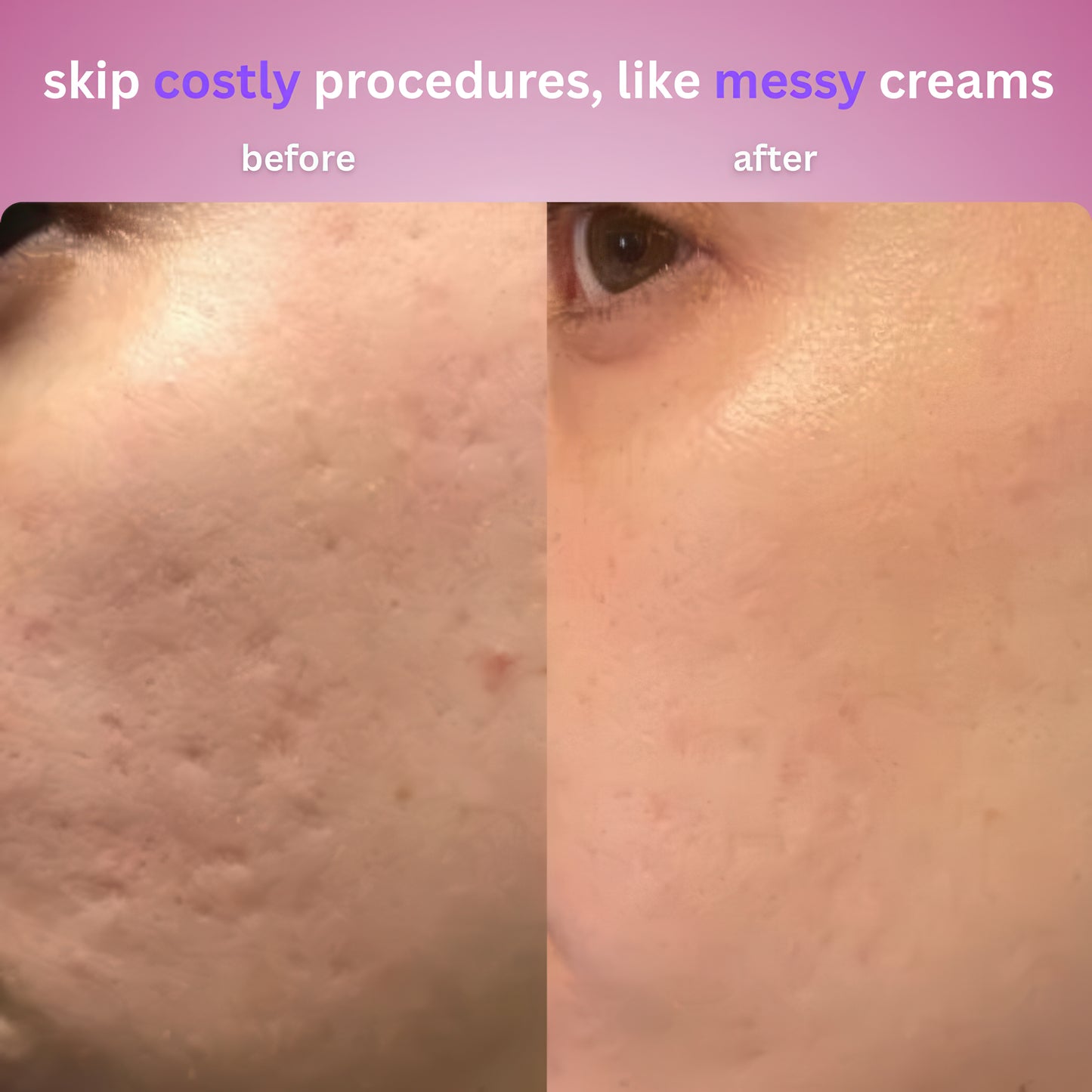 Skinblizz Silicone Scar Tape