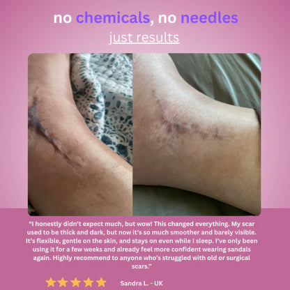 Skinblizz Silicone Scar Tape